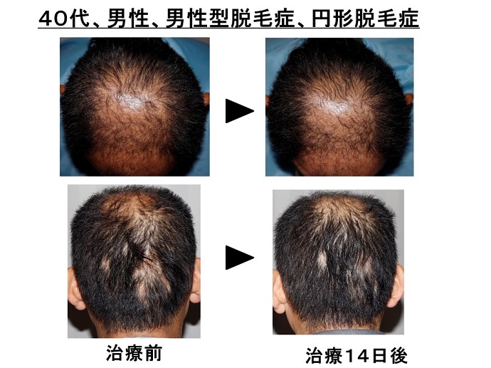 円形脱毛症　病院